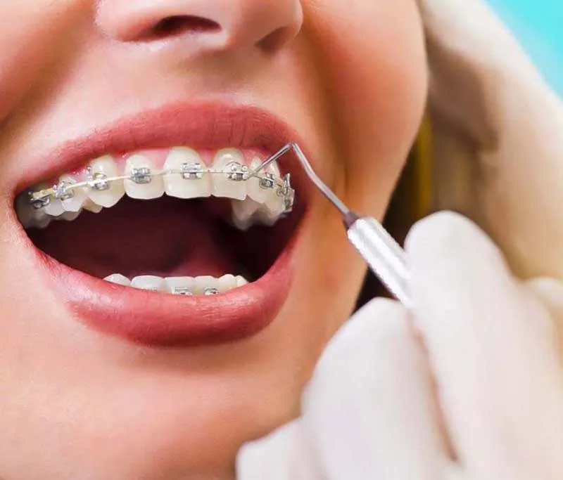 Những lưu ý khi thực hiện niềng răng sao cho hiệu quả