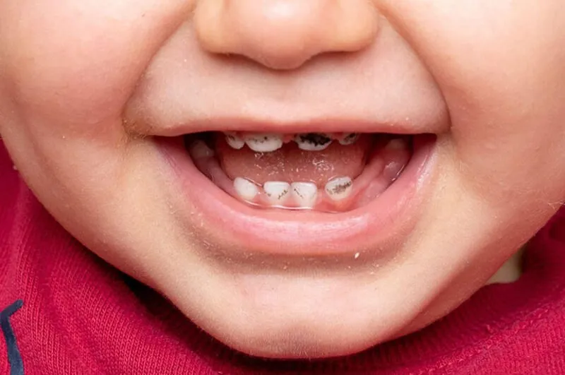 Quy trình điều trị tủy răng sữa trẻ em
