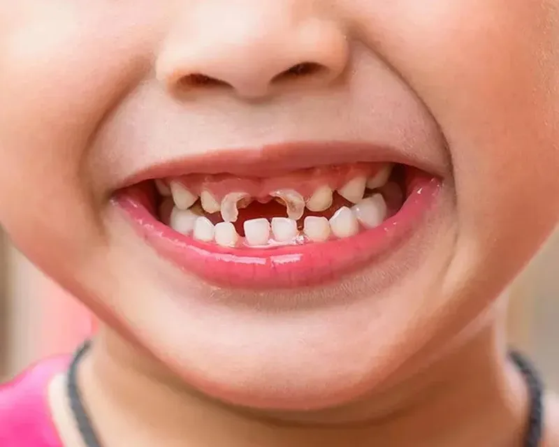 Các dấu hiệu cho thấy răng sữa bị chế tủy 