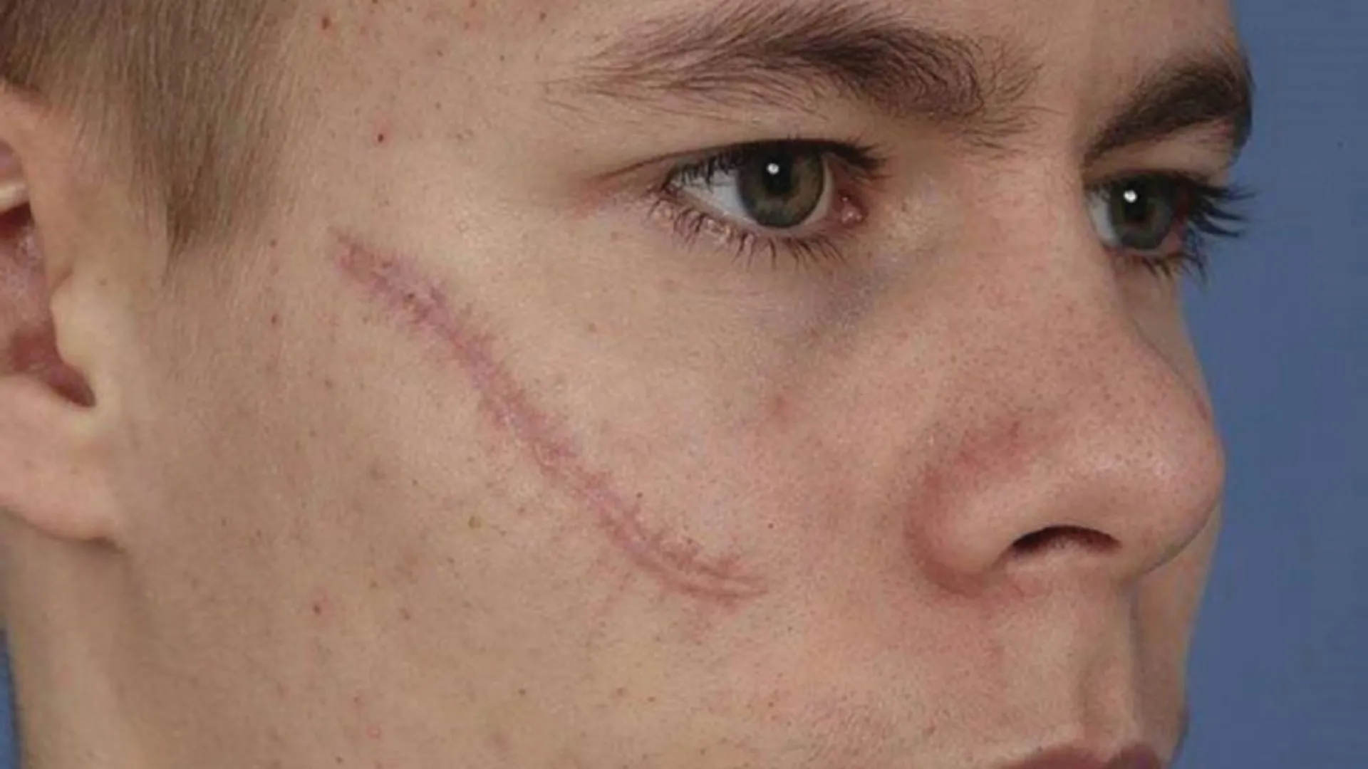 Chấn thương vùng hàm tác động đến thái dương hàm