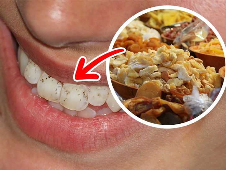 Hạn chế những thực phẩm gây hại cho răng