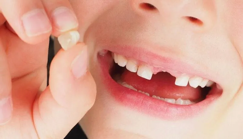 Răng sữa chưa rụng răng vĩnh viễn đã mọc có sao không?
