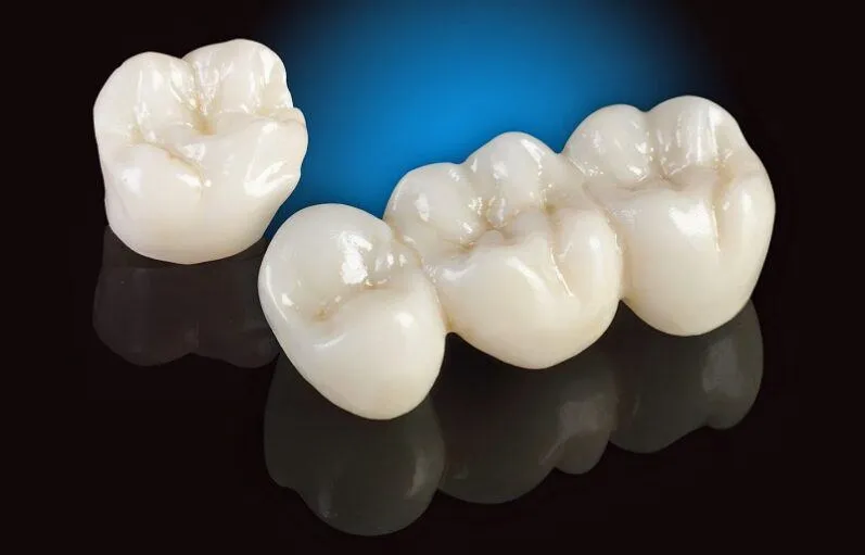 Răng Titan là gì?