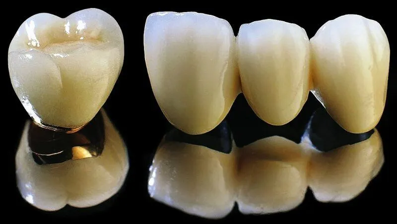 Khi nào nên phục hình bằng răng Titan?