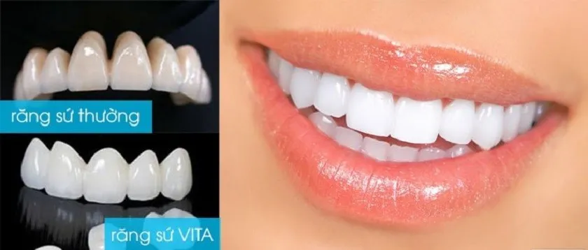 Răng sứ Titan Vita