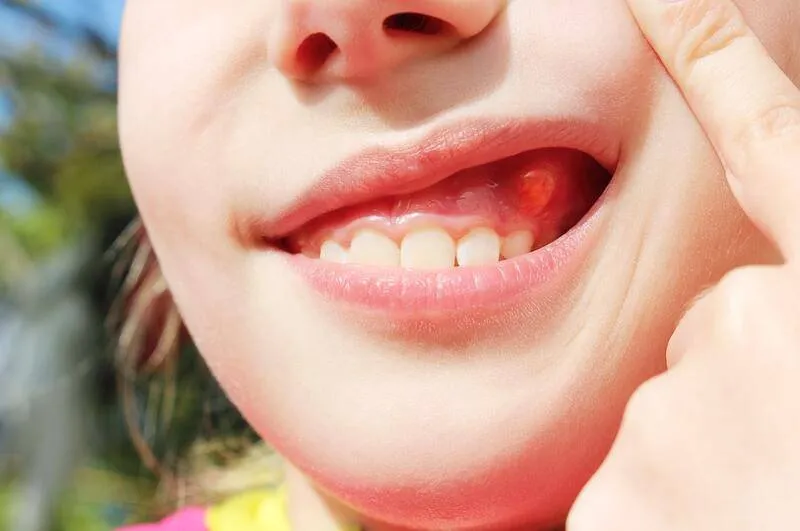 Dấu hiệu trẻ thay răng cần nắm rõ