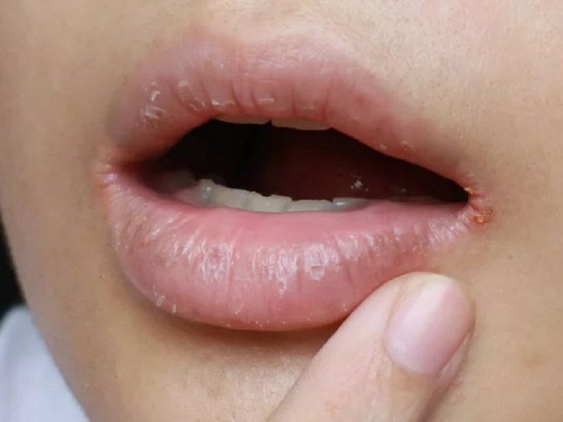 Khô miệng khiến bé 19 tháng tuổi bị hôi miệng