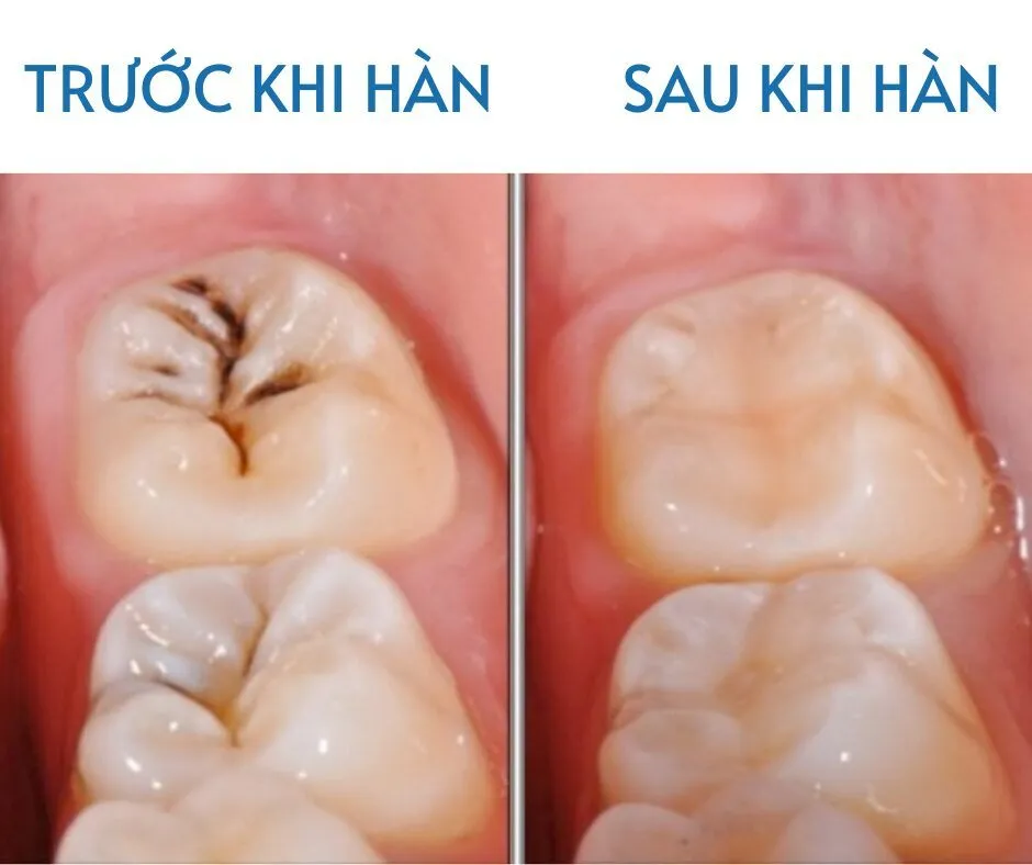 Có nên hàn răng cho bé 3 tuổi không?