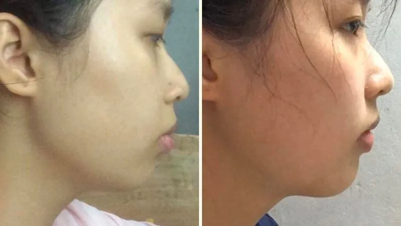 Hình ảnh góc nghiêng trước và sau khi niềng răng chi tiết