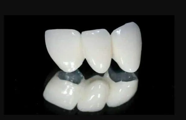 Răng sứ kim loại Titan là gì?