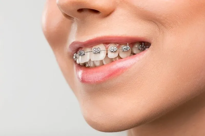 Răng bình thường có nên niềng không?