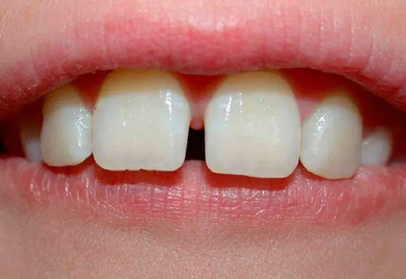 Răng thưa