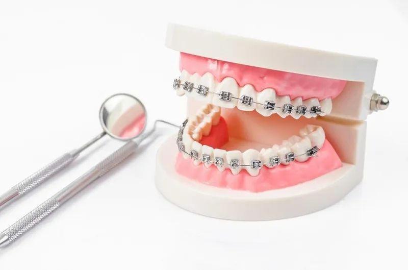 Những lưu ý trong quá trình niềng răng bạn cần biết