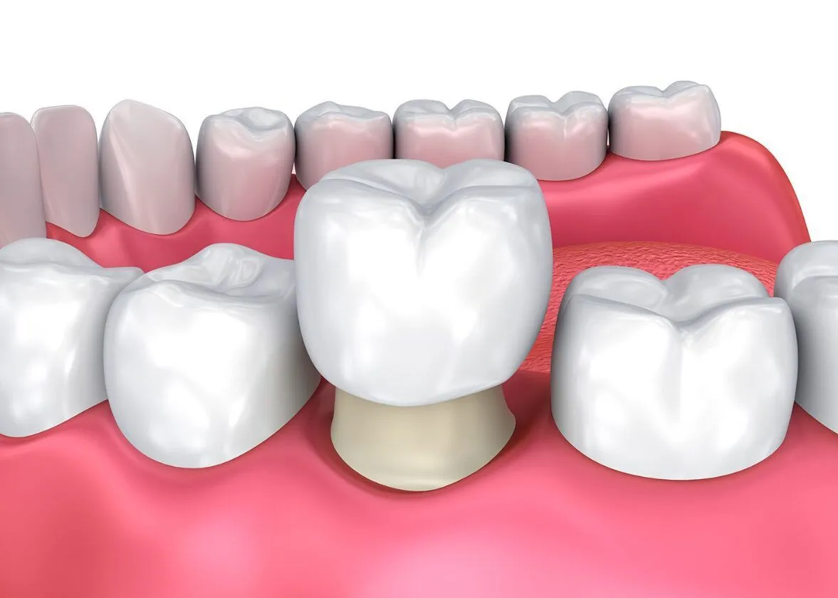 Bọc răng sứ thẩm mỹ và hiệu quả cao