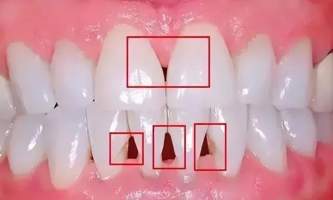 Tam giác đen ở răng là gì?