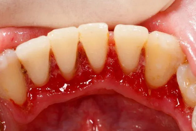 Chảy máu chân răng do viêm nướu (viêm lợi)