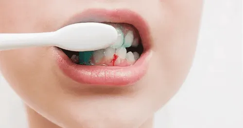Thường xuyên bị chảy máu chân răng khi đánh răng nguy hiểm không?