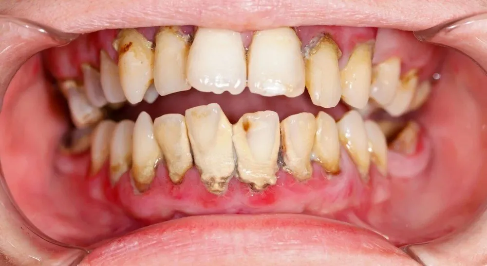 Mắc phải các bệnh về răng và quanh răng