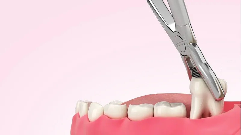 Những lưu ý để nhổ răng khôn hạn chế để lại lỗ