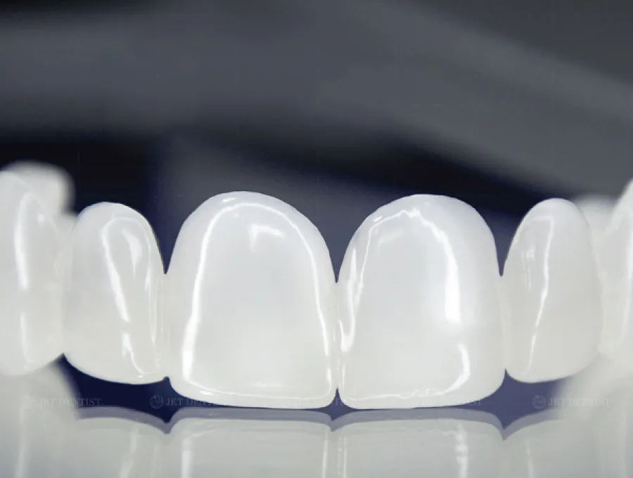 Mặt dán sứ Veneer Ultra White