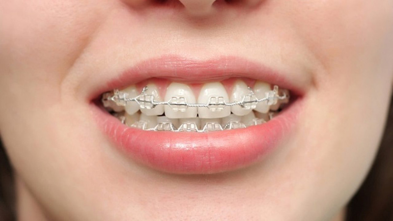 Bị hô nhẹ có nên niềng không?