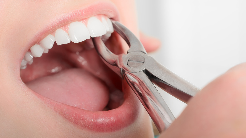 Bị hô nhẹ có phải nhổ răng khi niềng không?