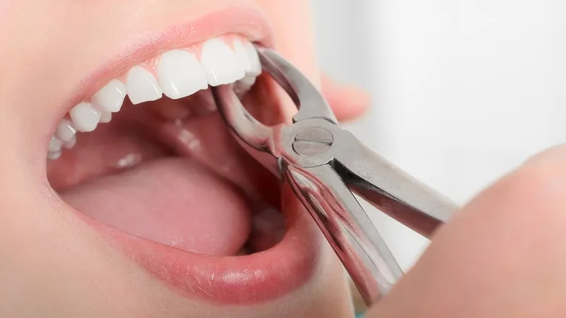 Bị hô nhẹ có phải nhổ răng khi niềng không?