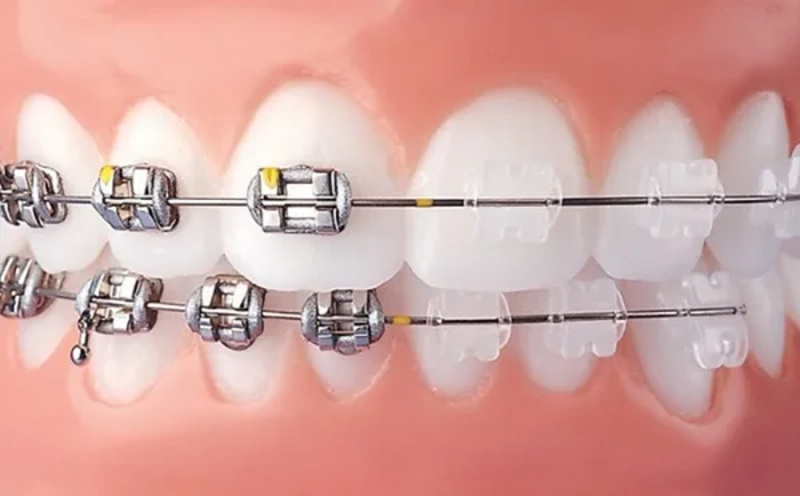 Quy trình niềng răng hô nhẹ chuẩn nhất hiện nay