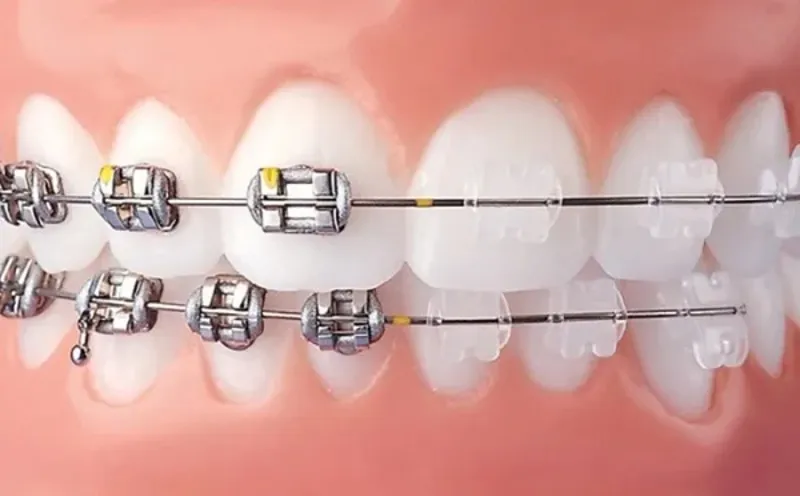 Quy trình niềng răng hô nhẹ chuẩn nhất hiện nay