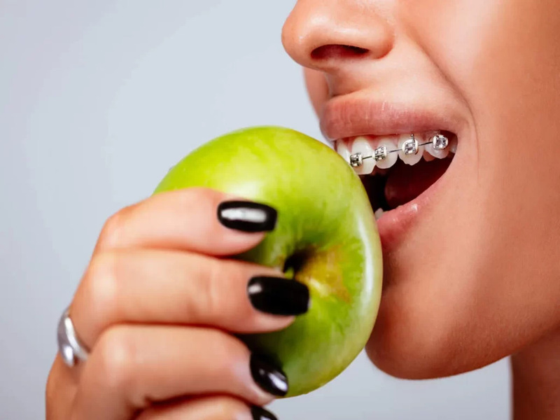 Lời khuyên cho người bị hô nhẹ chuẩn bị niềng răng