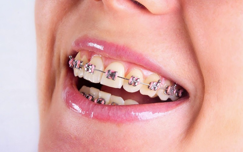 Các phương pháp niềng răng hô nhẹ hiện nay - Niềng kim loại