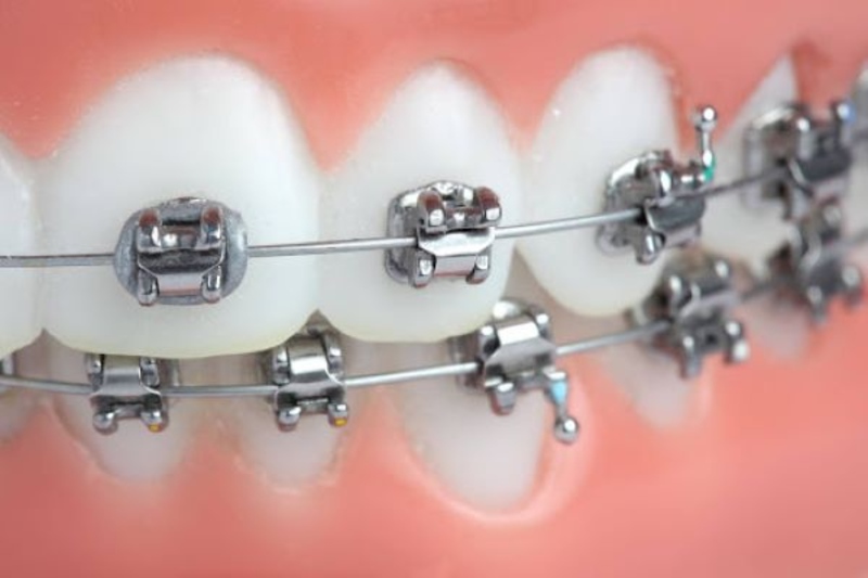 Niềng răng mắc cài kim loại tự buộc cho răng hô nhẹ