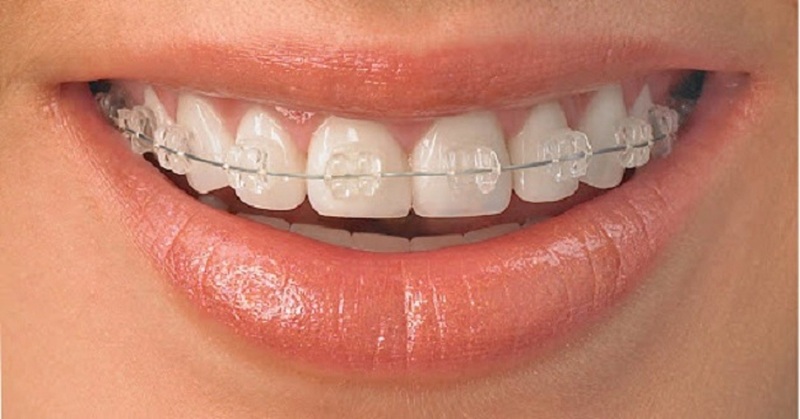 Niềng răng mắc cài sứ cho răng hô nhẹ