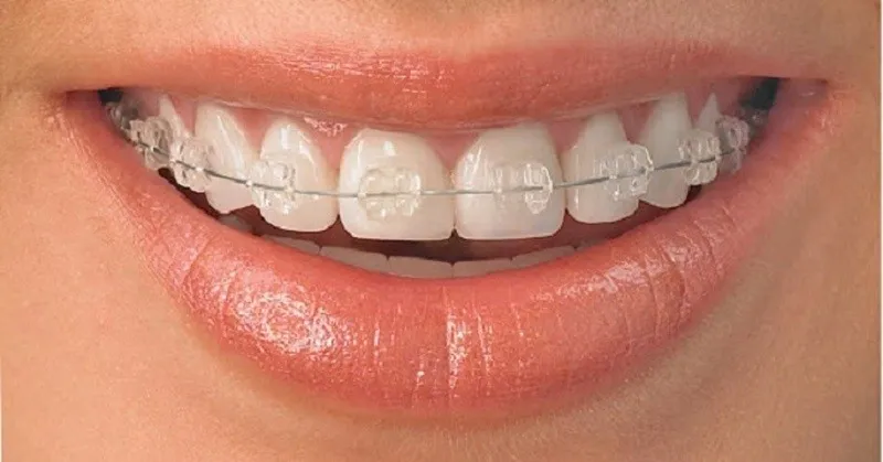Niềng răng mắc cài sứ cho răng hô nhẹ