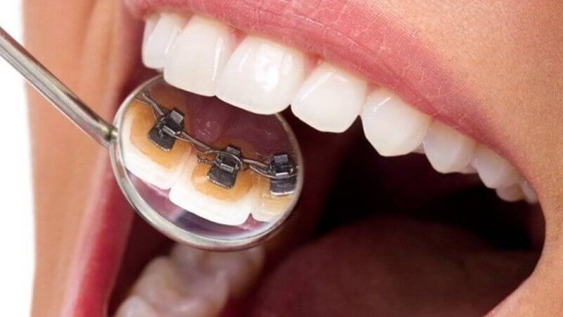 Niềng răng mắc cài mặt trong (mặt lưỡi)