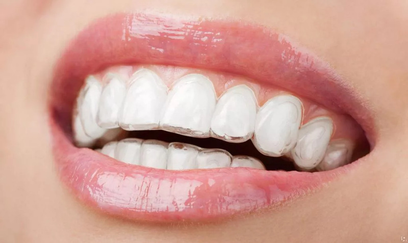 Thời gian niềng răng hô nhẹ mất bao lâu?
