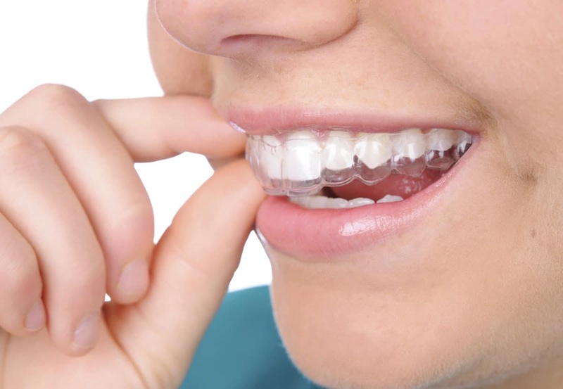 Thế nào là răng hô nhẹ?