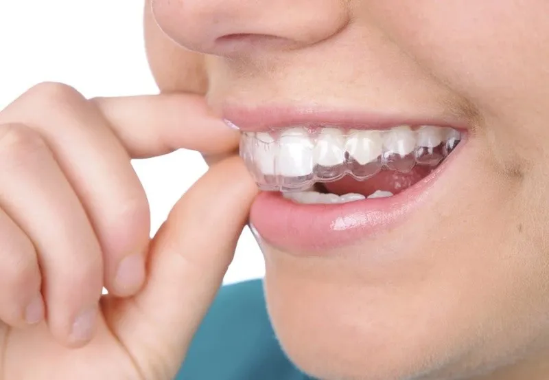 Thế nào là răng hô nhẹ?