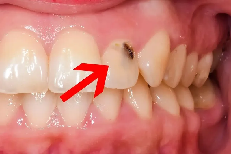 Vị trí thường gặp khi bị sâu kẽ răng
