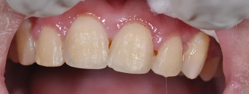 Sâu kẽ răng là gì?
