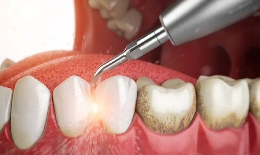 Vì sao nhiều người chọn làm sạch cao răng tại nhà?