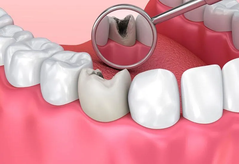 Ảnh hưởng của hôi miệng cho răng ra sao?