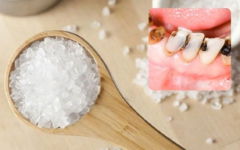 Cách trị sâu răng hôi miệng tại nhà với nước muối loãng