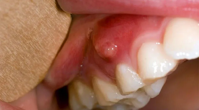 Các dấu hiệu phổ biến của bệnh sưng nướu răng có mủ