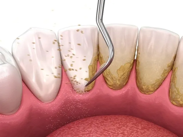 Giải pháp điều trị cao răng màu đen tại nha khoa