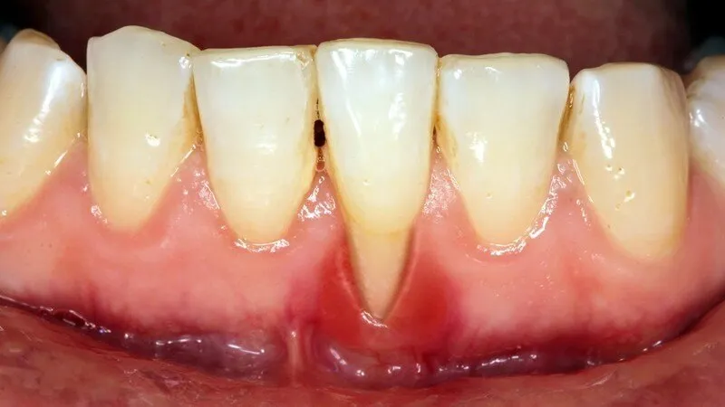Gây tụt nướu, tăng nguy cơ mất răng
