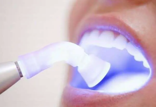 Tẩy trắng răng bằng ánh sáng Plasma