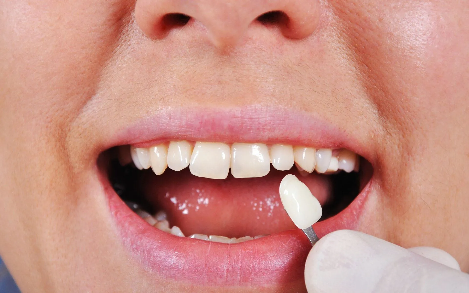 Thực hiện kỹ thuật dán sứ Veneer không đúng chuẩn