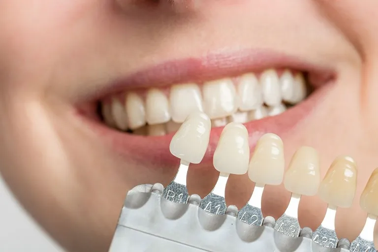 Những lưu ý khi đã biết được dán sứ Veneer có mấy loại