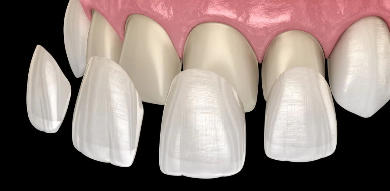 Trường hợp nào cần dán sứ Veneer